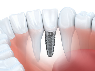 Pansement dentaire : rôle, durée d'utilisation, matériaux