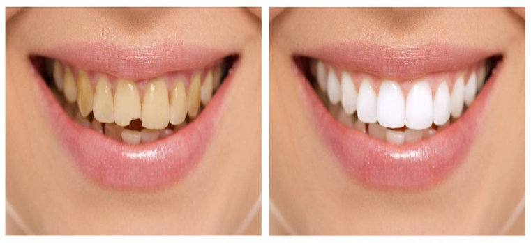 Pose de facettes dentaires : temps et efficacité