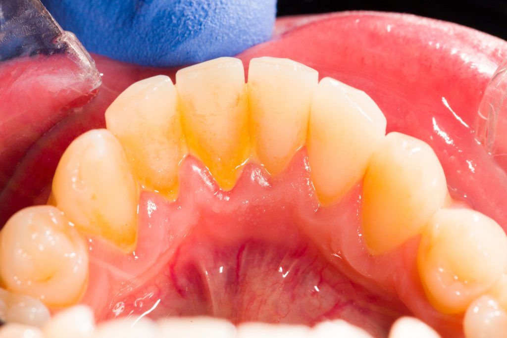 Tartre Dentaire et Détartrage des dents, les causes ? - Tout Dentaire